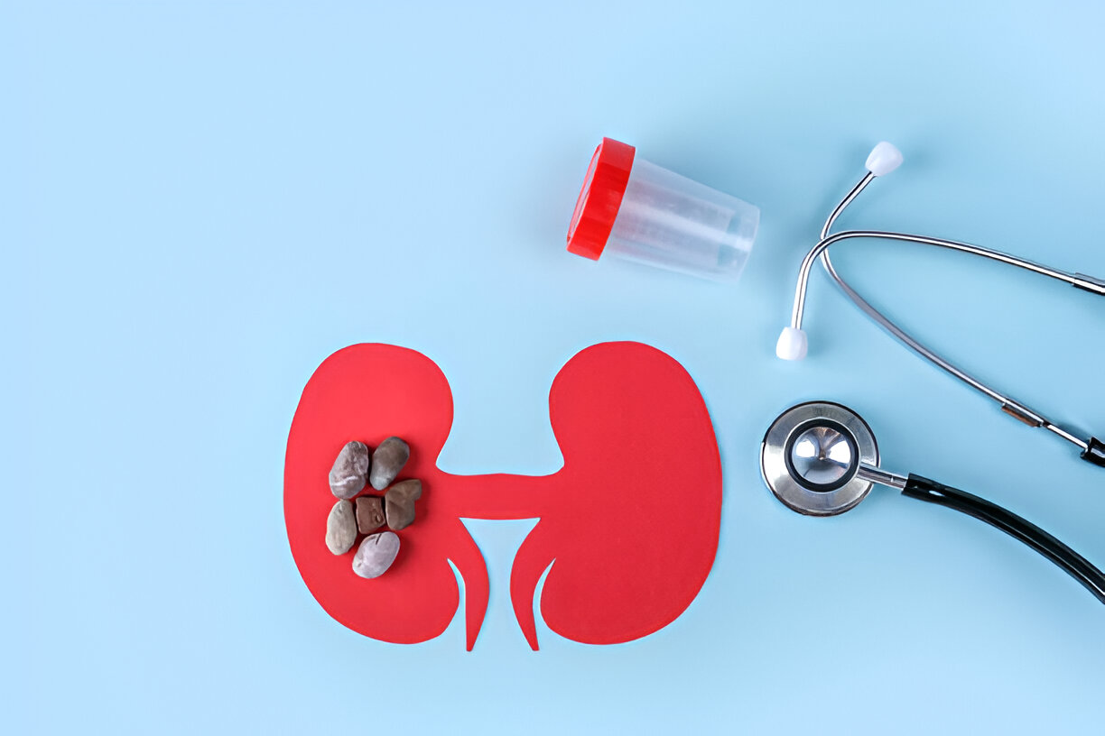 Kidney Stone Treatment & Prevention
